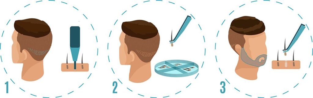 Beard Transplant Turkey