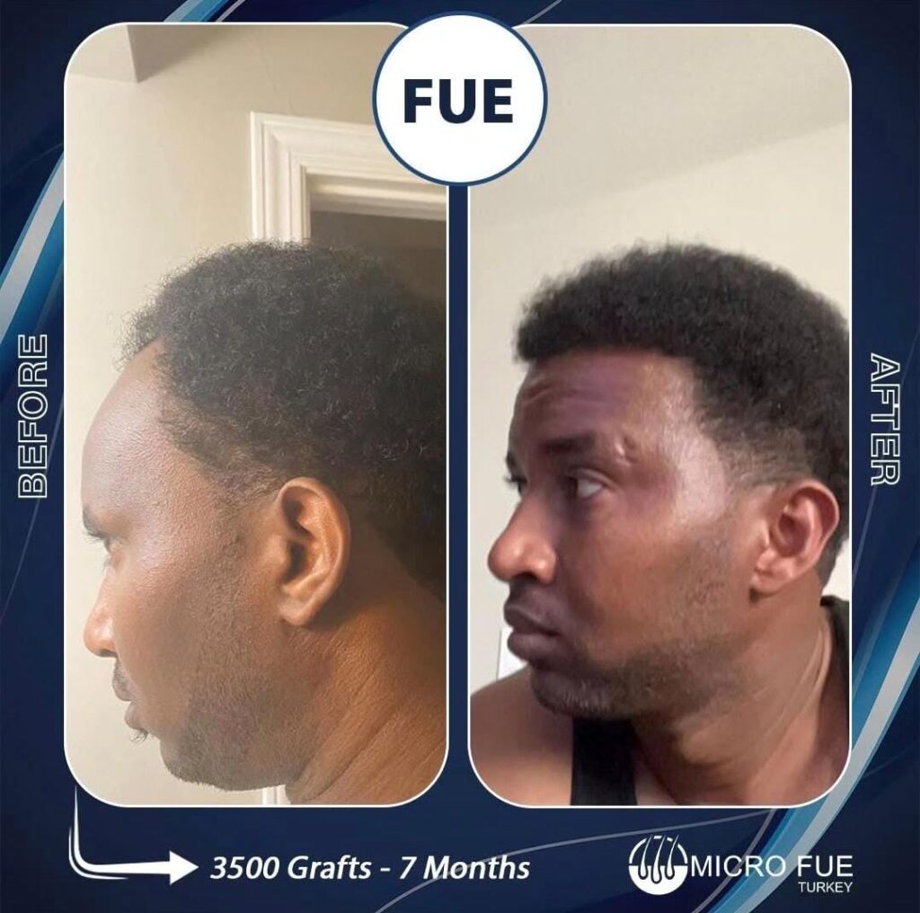 Afro Hair Transplant Turkey
