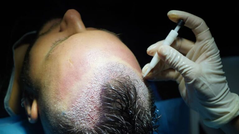 Hair Implants in Turkey