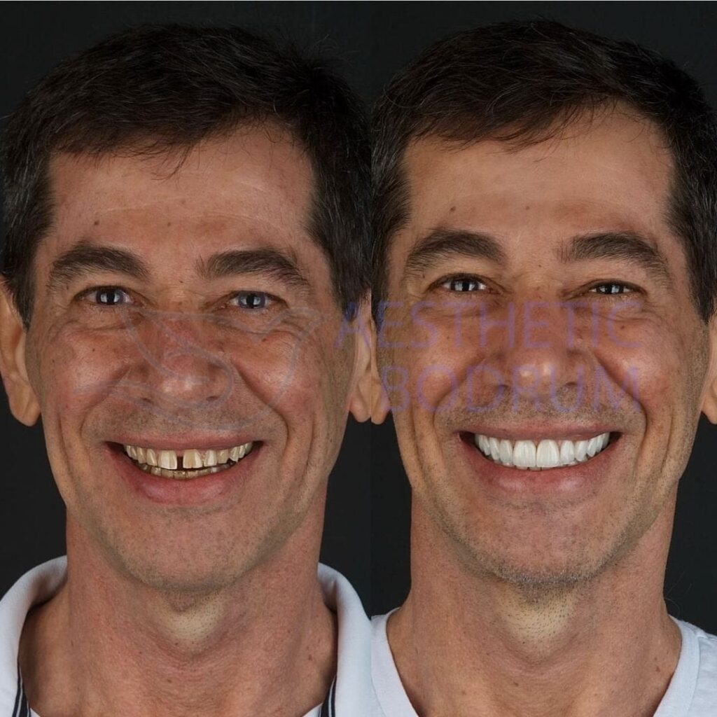 Dentist in Didim Before After