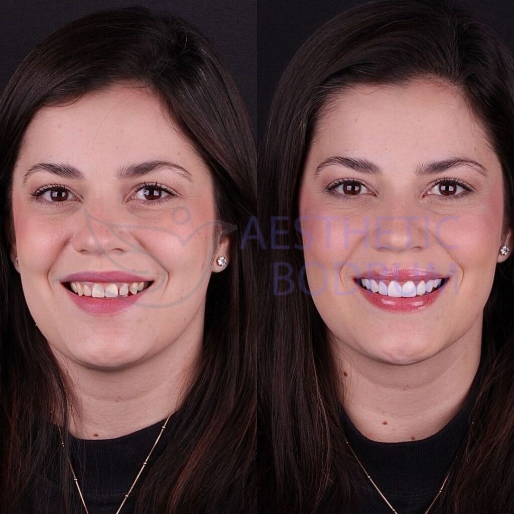 Dentist in Didim Before After