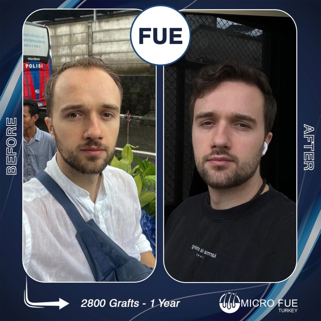 Hair Transplant in Antalya