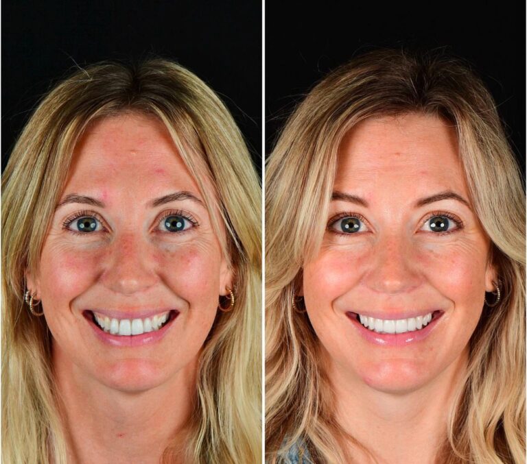 Teeth Whitening in Şişli, Istanbul