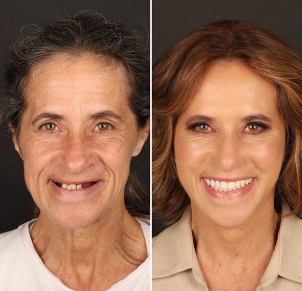 Same-Day Dental Implant Treatment