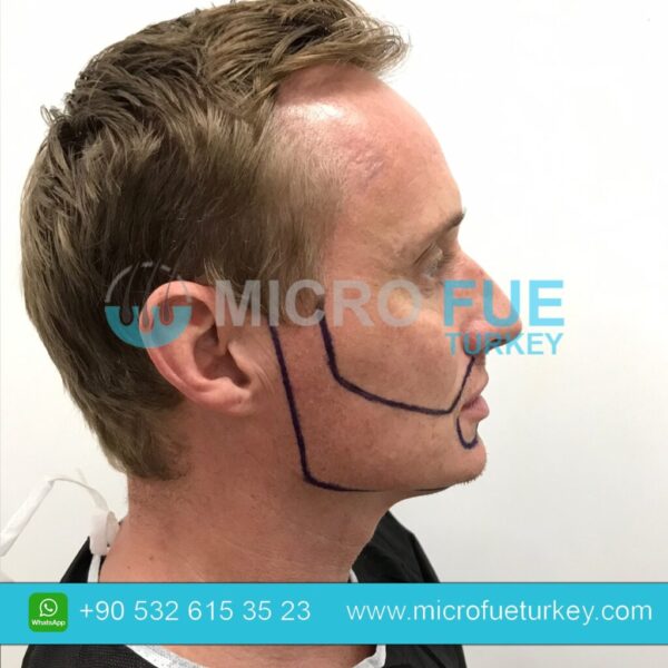 Beard Transplant Procedure Step-by-Steps