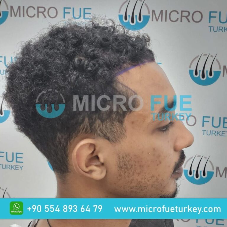 Hair Transplant in Taksim