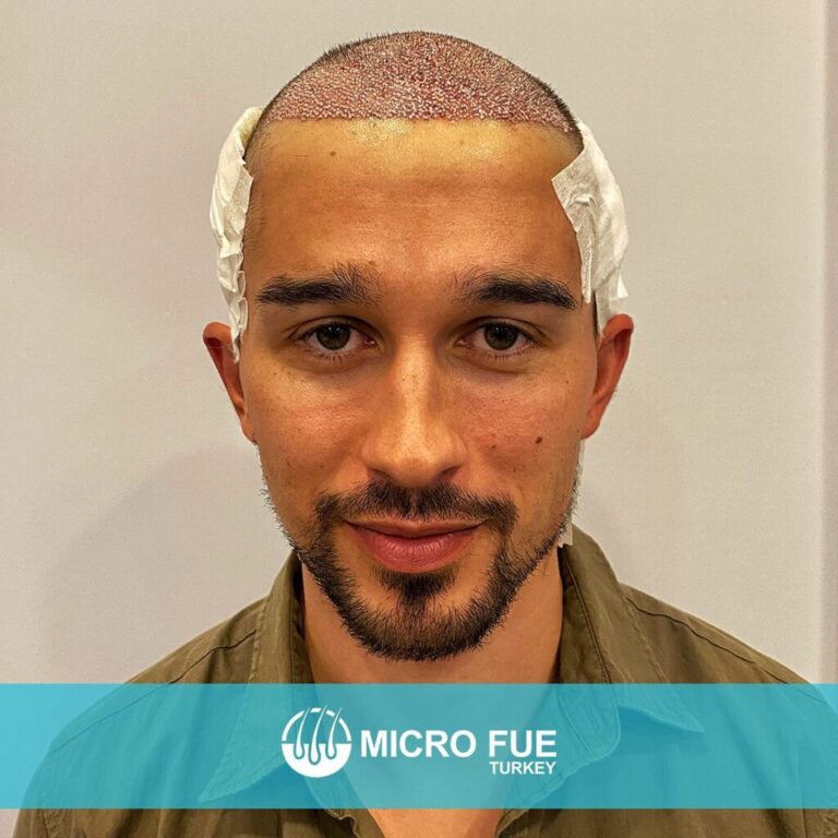 Hair Transplant Istanbul