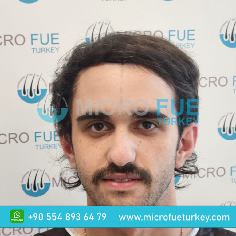 Hair Transplant Turkey