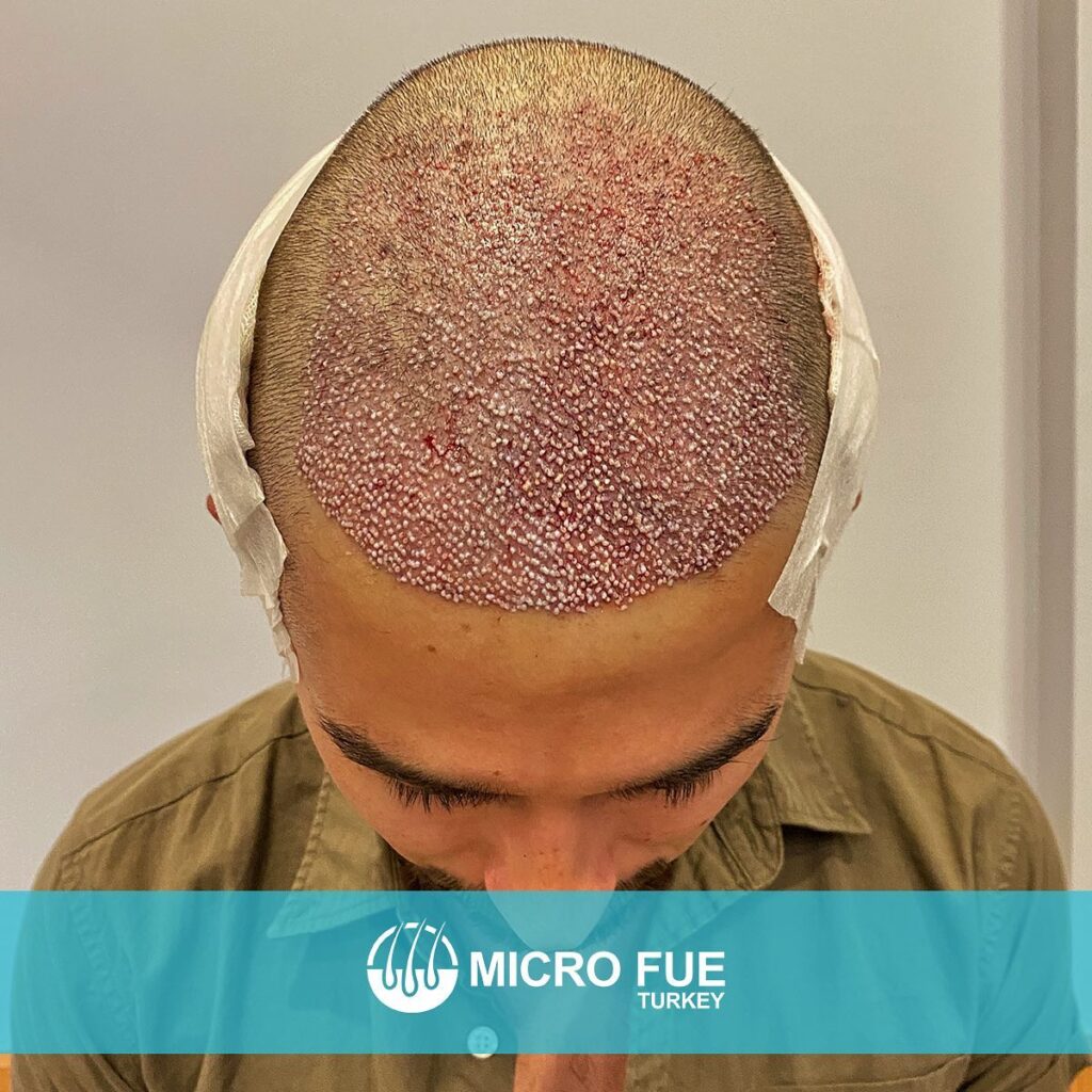 Hair Transplant Istanbul