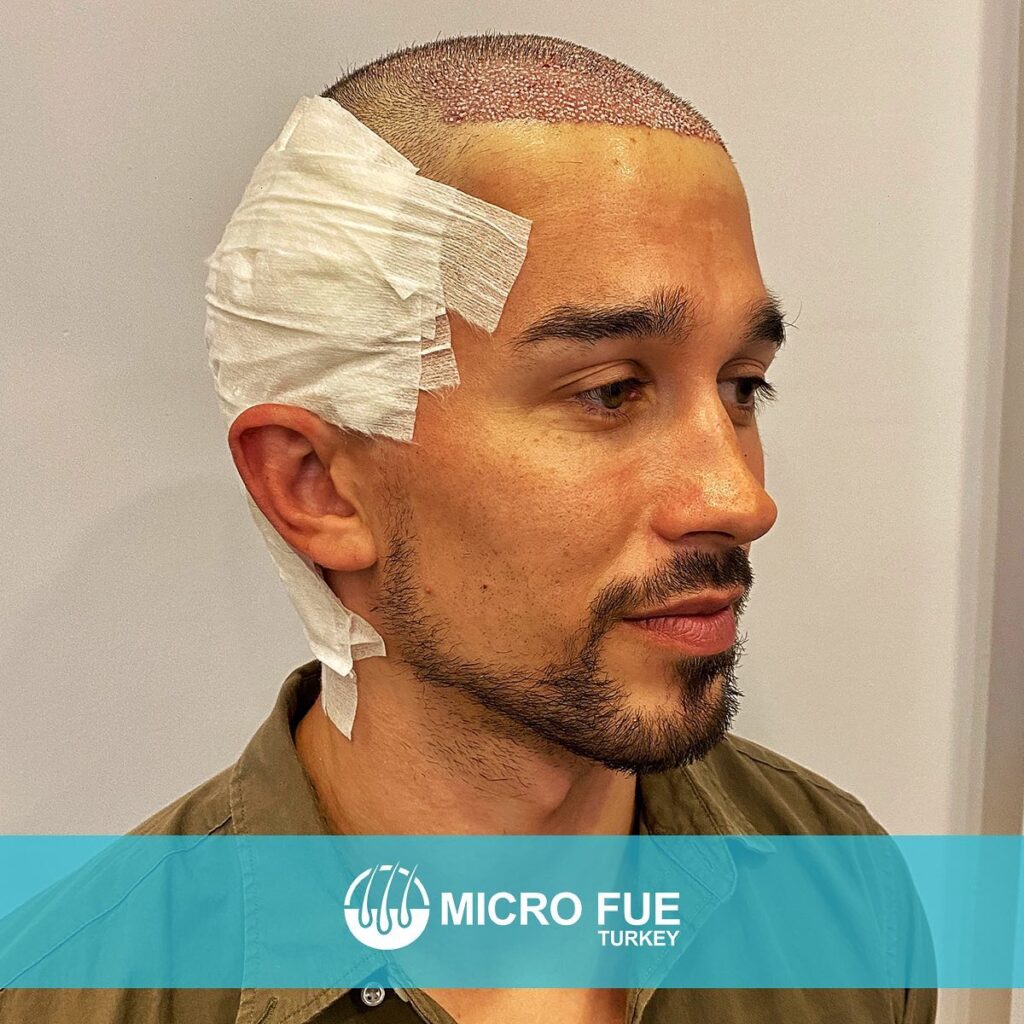 Hair Transplant Istanbul