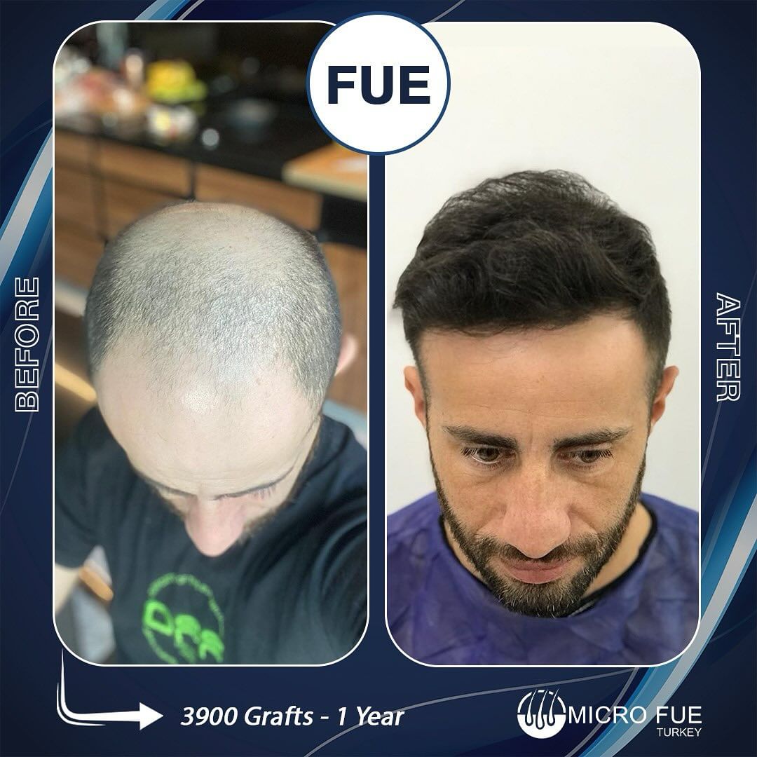 Hair Transplant Fethiye