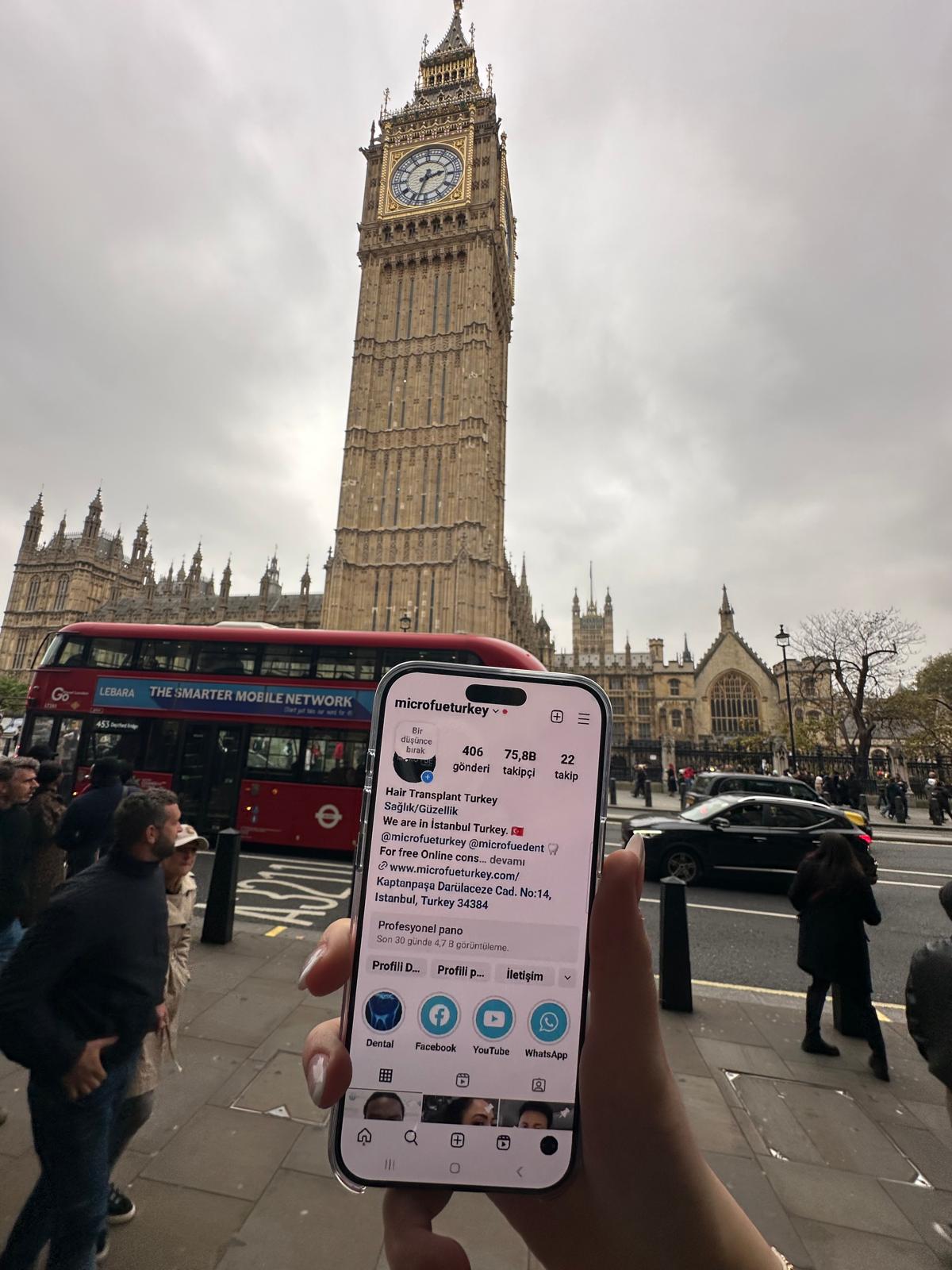 Hair Transplant in London