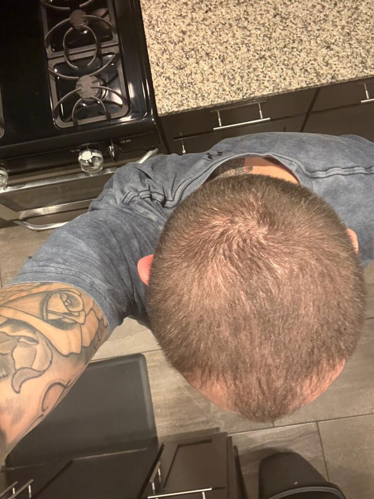 Good Candidate for FUE Hair Transplantation