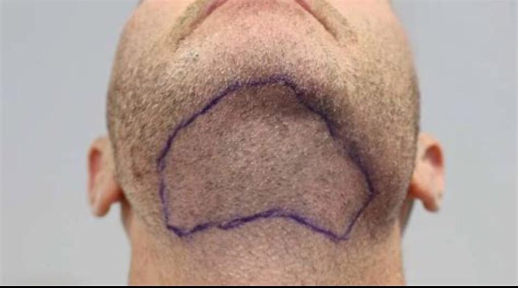 The Beard A Perfect Donor Area