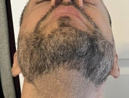 Beard Hair Transplant