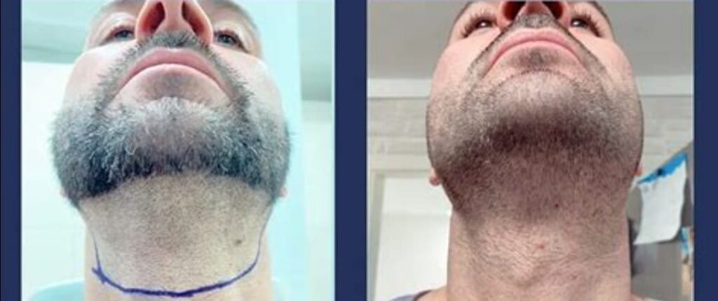 Beard Donor Area Before After