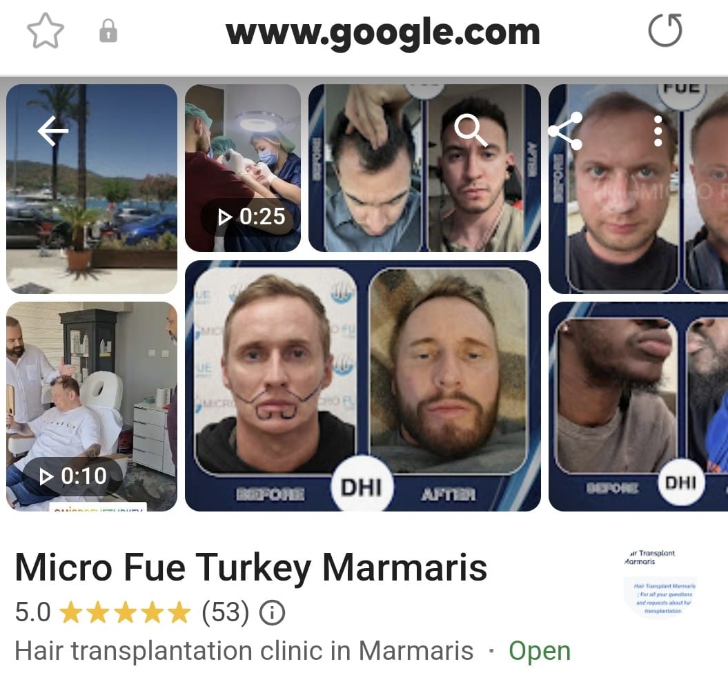 Marmaris Hair Transplant Reviews