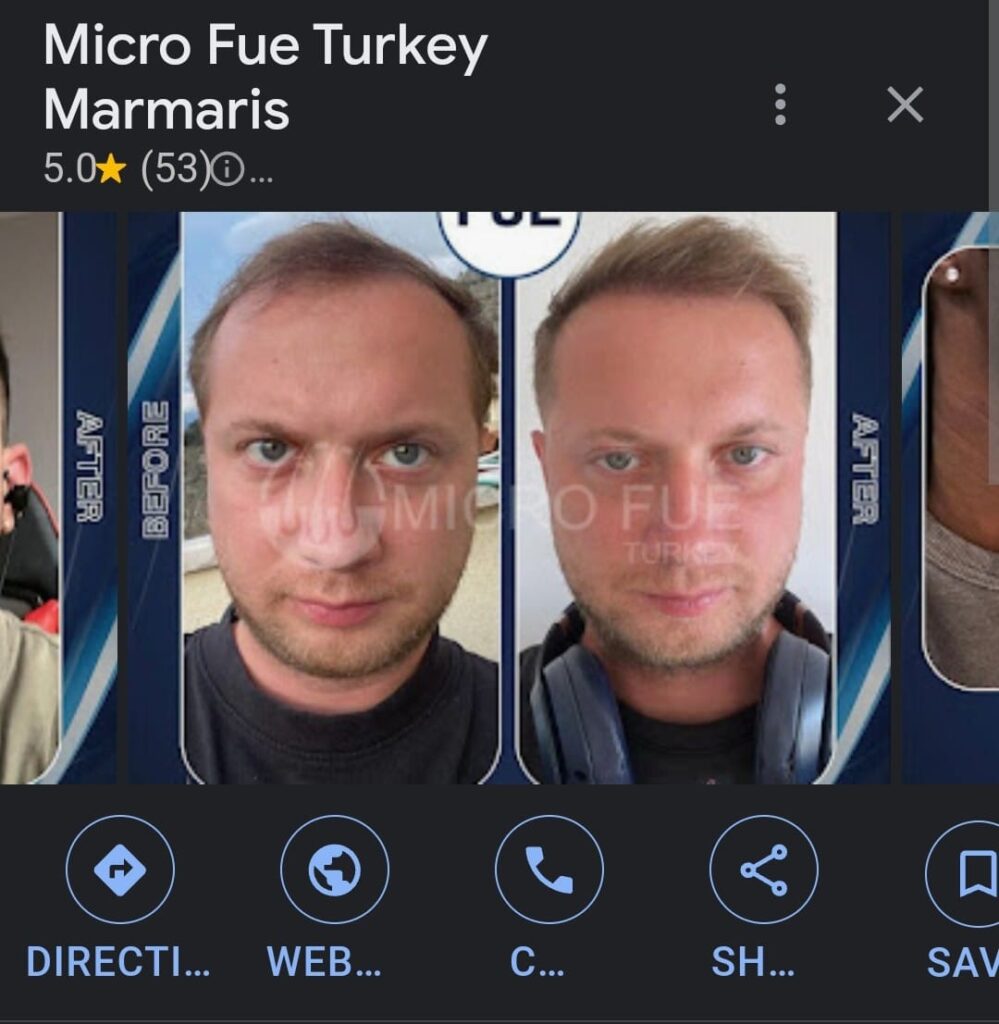 Marmaris Hair Transplant Reviews