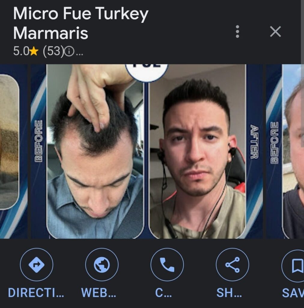 Marmaris Hair Transplant Reviews