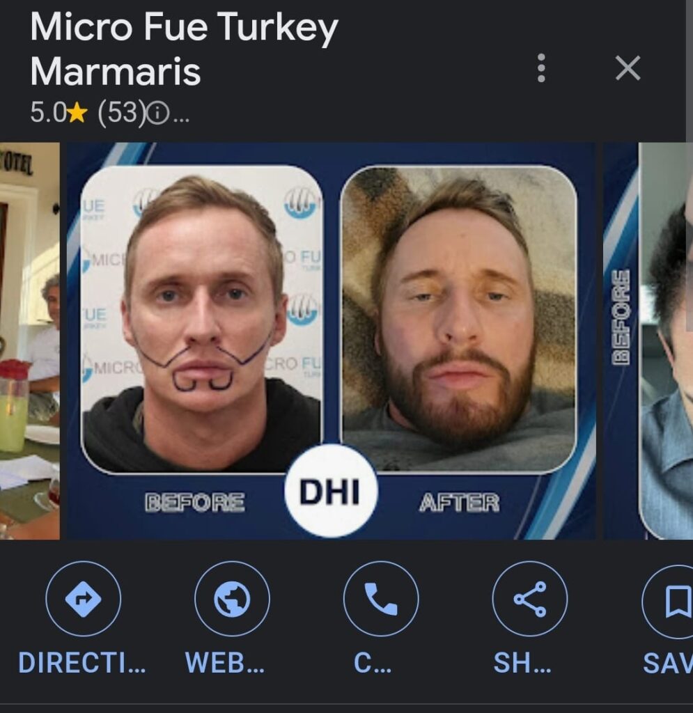 Marmaris Hair Transplant Reviews