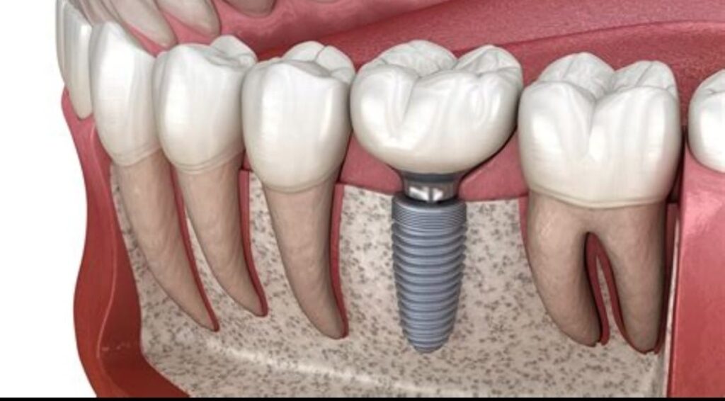 Dental Implants Fethiye
