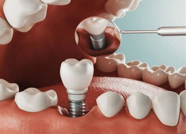 Şişli'de Diş İmplantı
