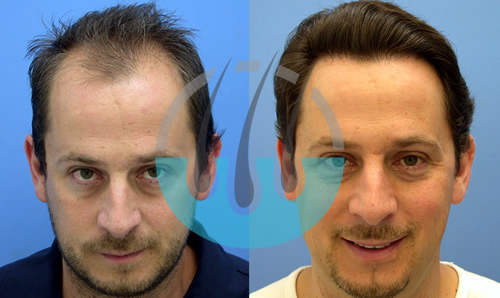Hair Transplant Antalya Before After