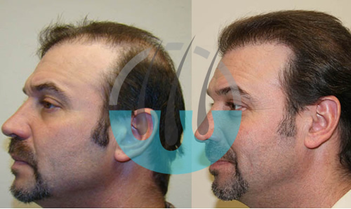 Transplant in Marmaris Before After