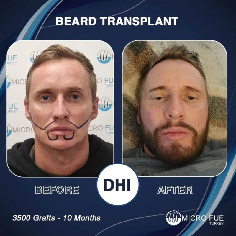 Beard Transplant Cost Turkey
