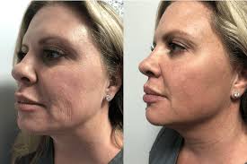 Botox Bodrum Before After