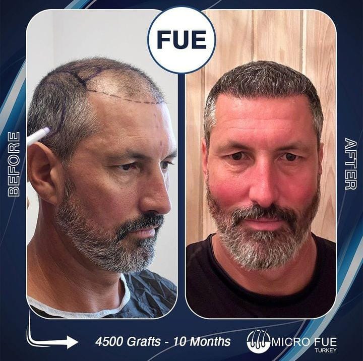 Affordable Hair Transplant Antalya