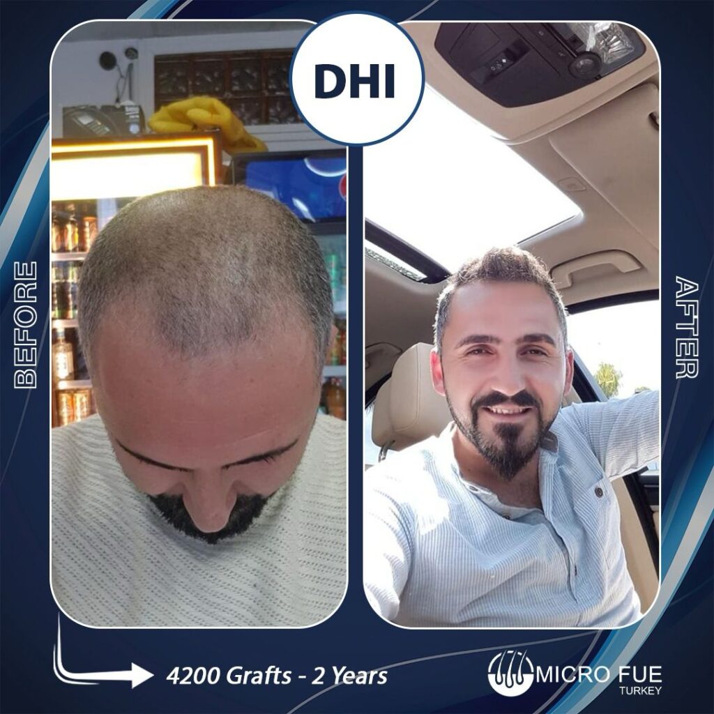 Безбритвенная трансплантация волос в Анталии
