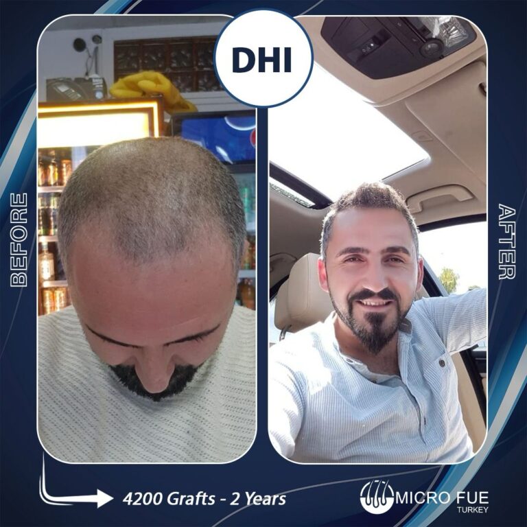 Безбритвенная трансплантация волос в Анталии