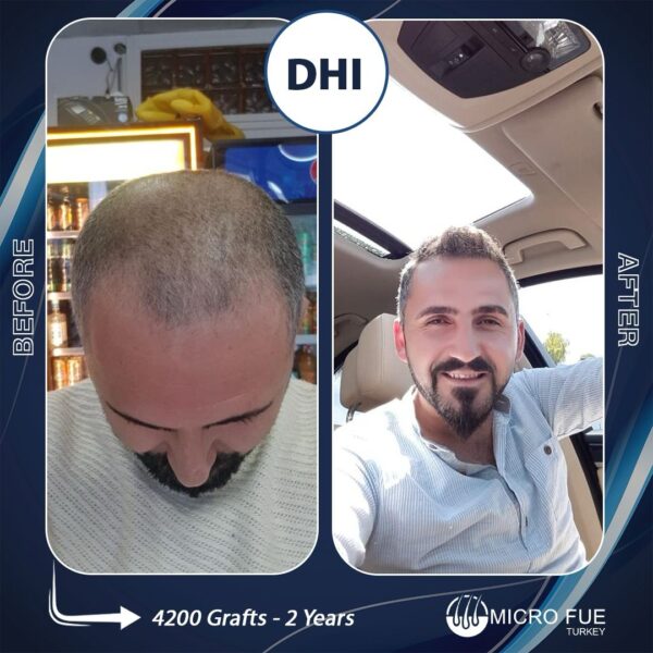 Безбритвенная трансплантация волос в Анталии