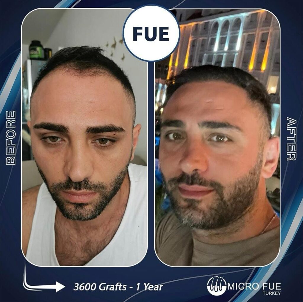 Hair Transplant in Alanya Before  After
