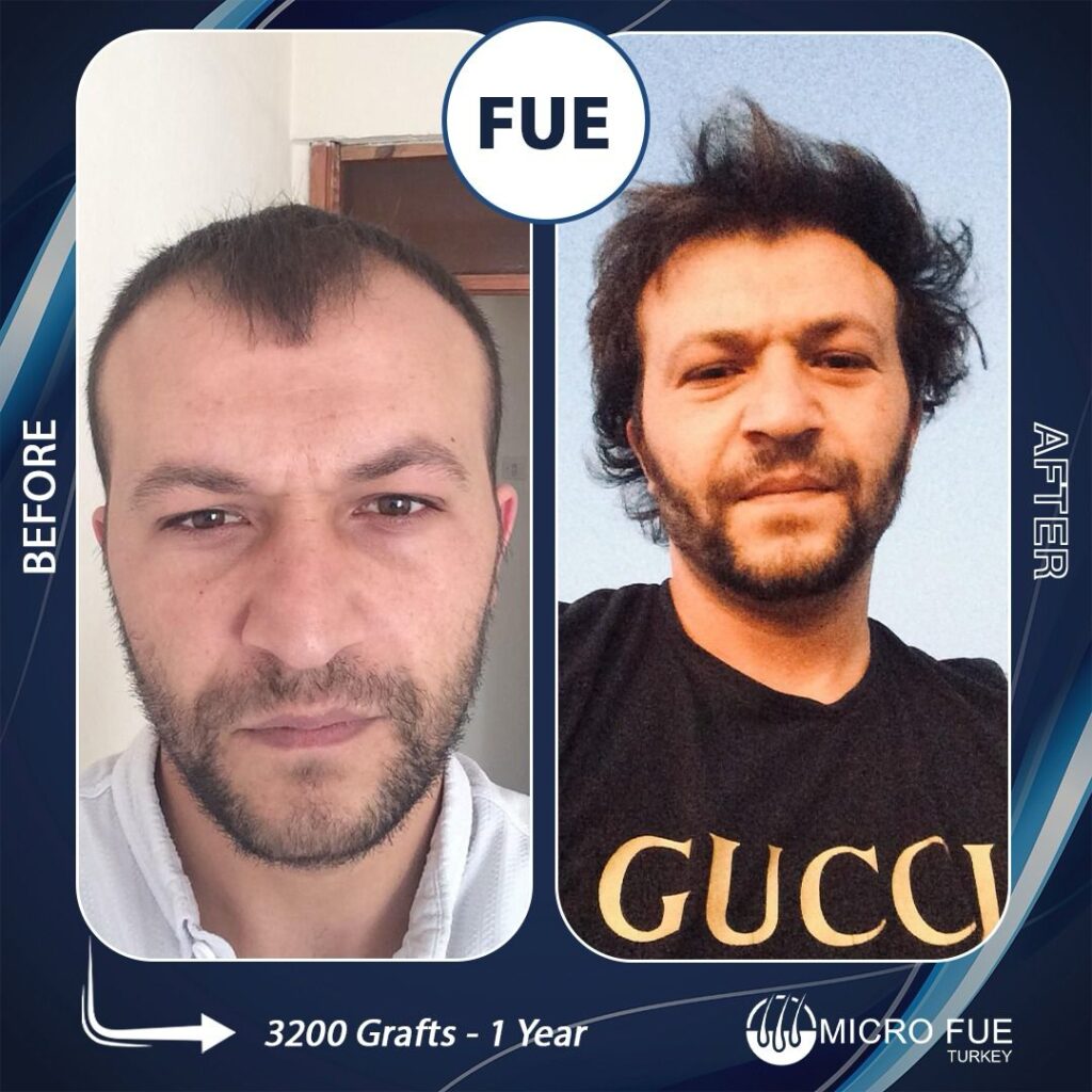 Hair Transplant in Alanya Before  After