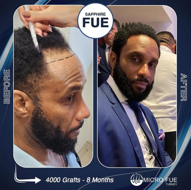 Afro Hair Transplant Turkey
