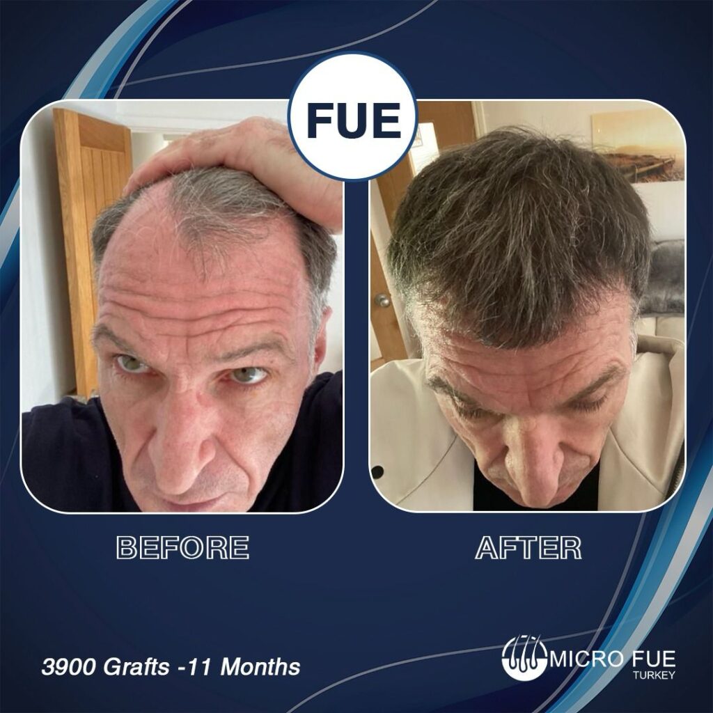 FUE Hair Transplant Alanya Before After