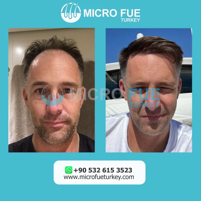 Antalya Hair Restoration
