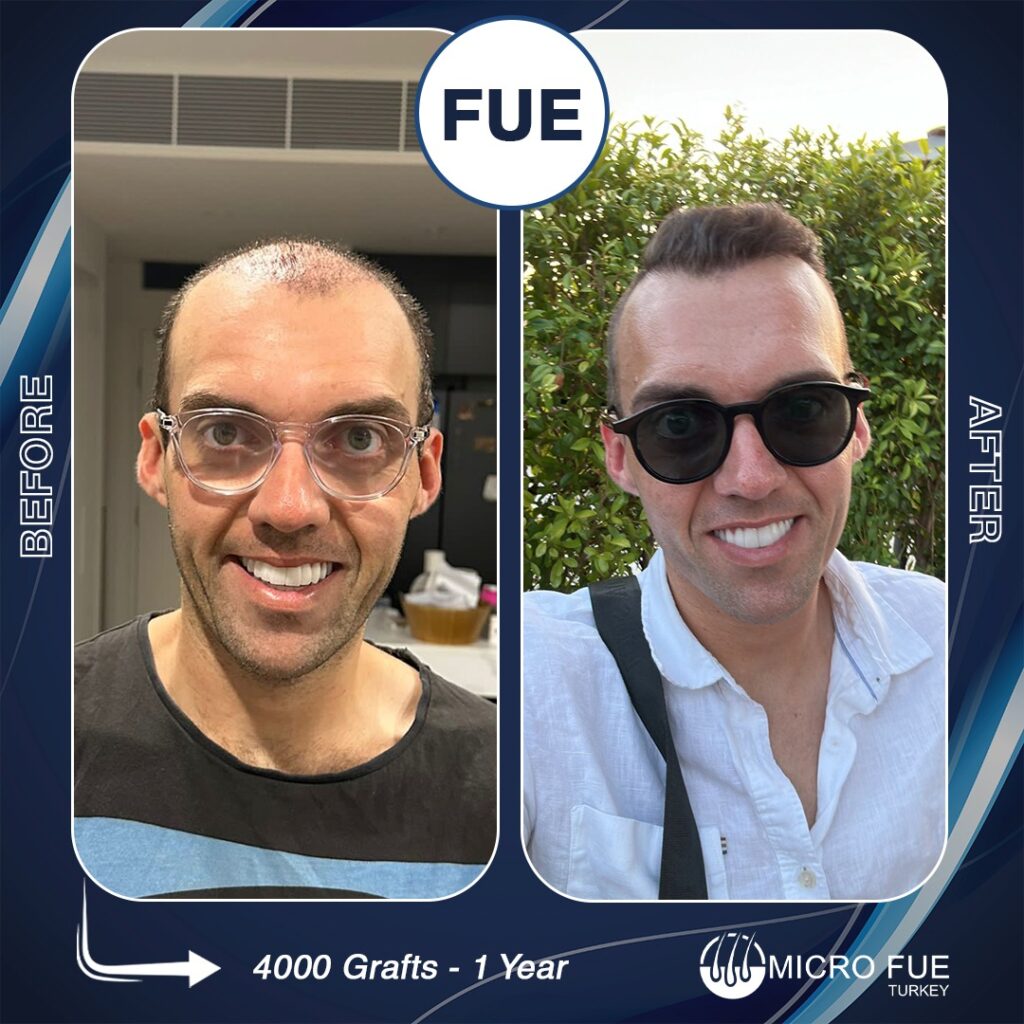 Hair Transplant Antalya Prices