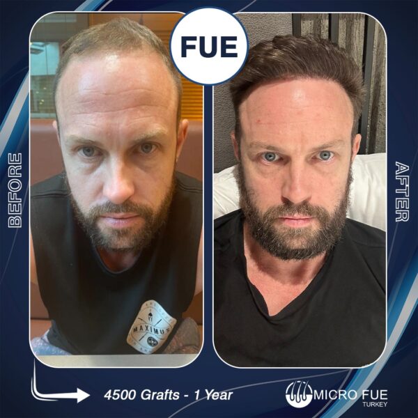 Hair Transplant in Marmaris for UK Tourists