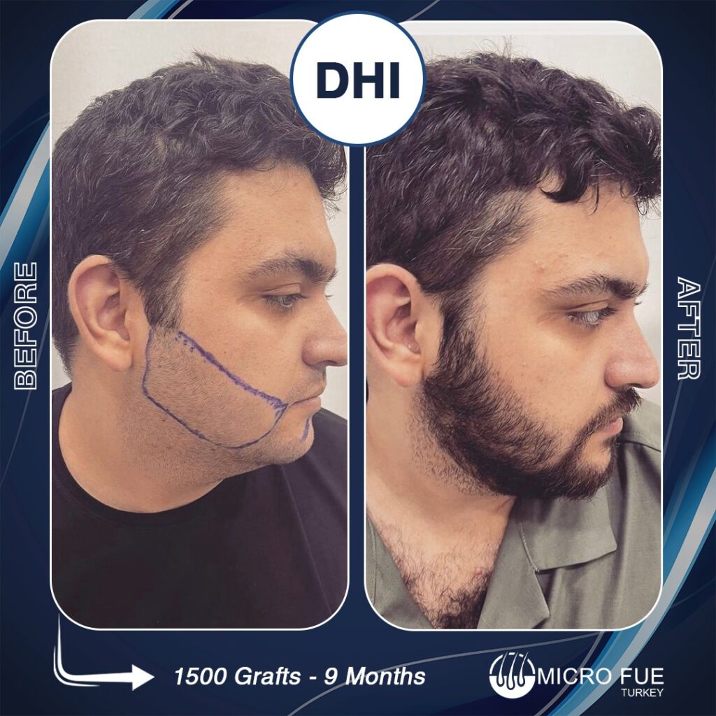 Beard Transplant in Antalya