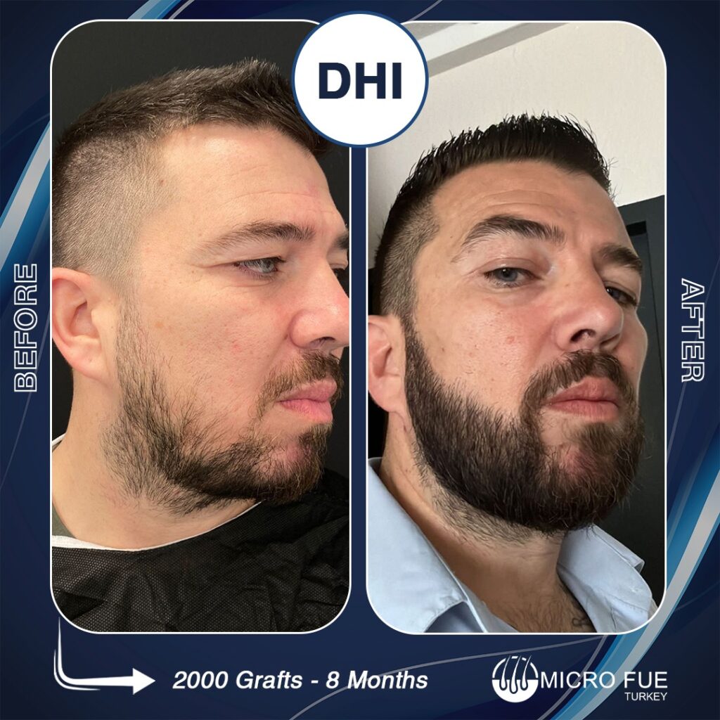 Dhi Beard Transplant