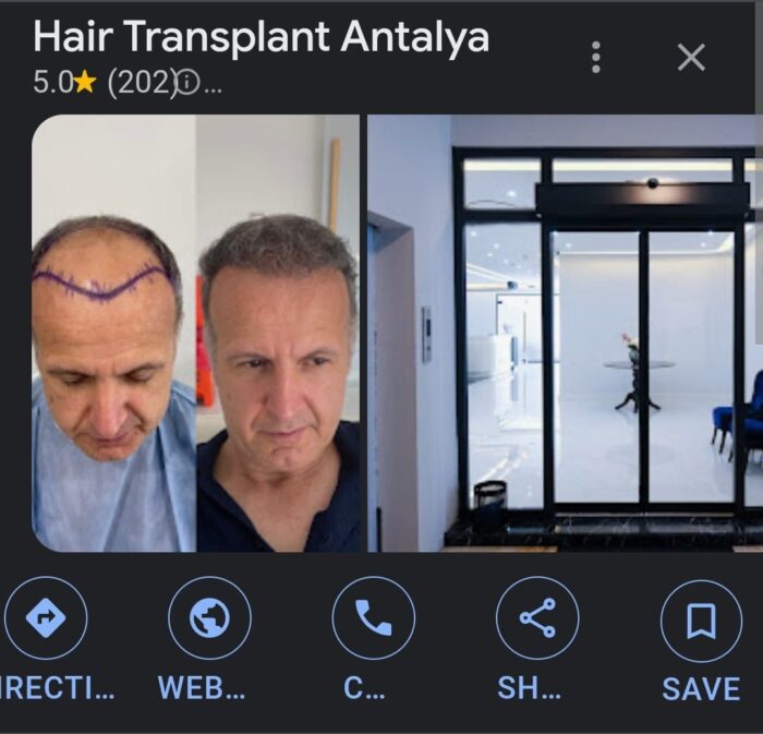 Hair Transplant Antalya