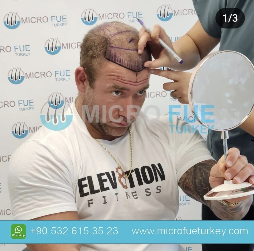 Hair Transplant Journey with Micro FUE Turkey: An Interview with Jake Kenney