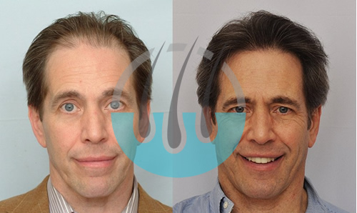 Saç Ekimi Bodrum Öncesi Sonrası