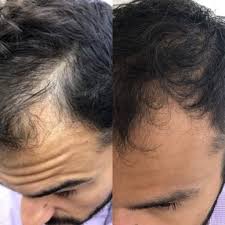 PRP Hair Treatment Turkey Before After