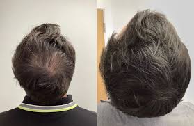 Hair PRP Treatment Şişli Before After
