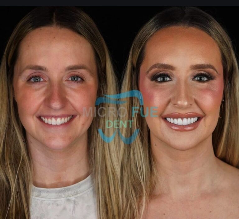 20 Композитных Виниров в Анталье