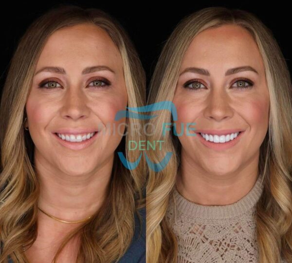 Teeth Whitening in Antalya Before After